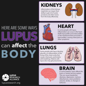 Ways Lupus Can Affect the Body Infographic from Lupus Research Alliance