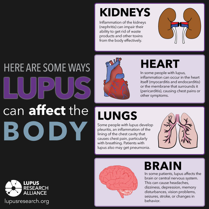Ways Lupus Can Affect the Body Infographic